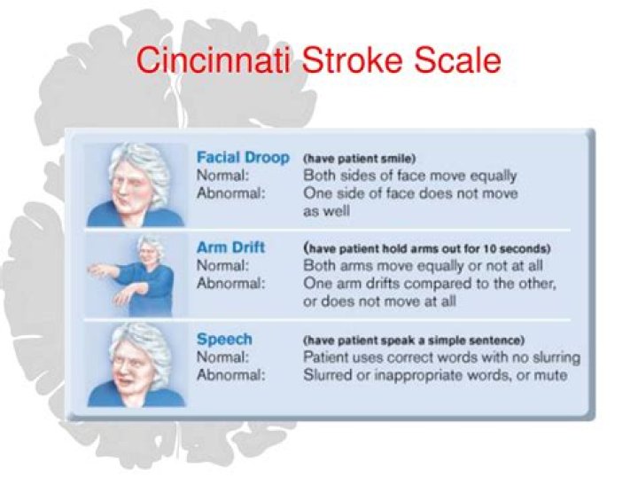 cincinnati stroke scale