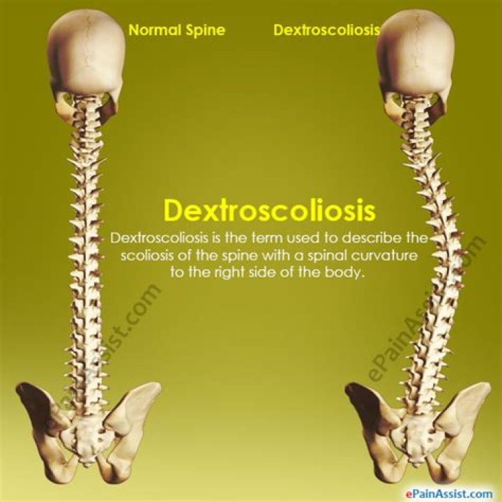 dextroscoliosis