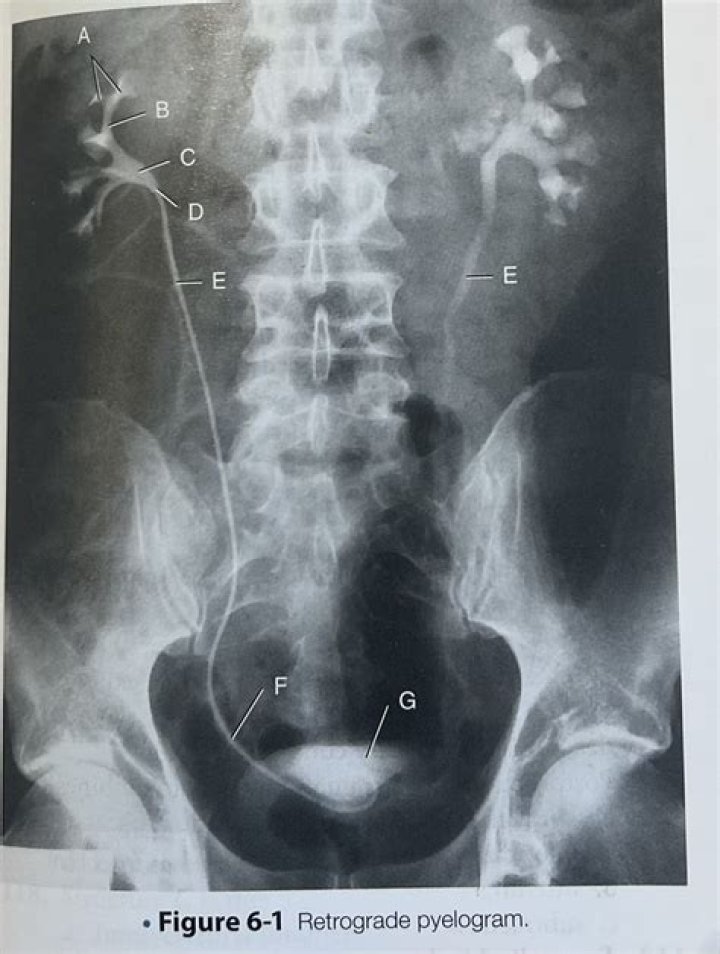 retrograde pyelogram