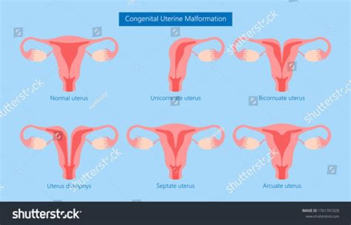 tilted cervix
