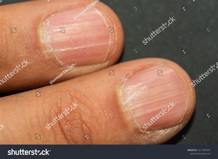 vertical ridges on nails vitamin deficiency