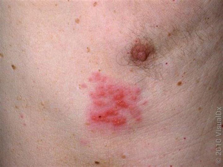 what does shingles look like